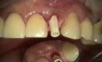 Immediate Implant And Provisional Upper Incisor