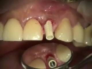 Immediate Implant And Provisional Upper Incisor