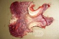 Endoscopy of Scirrhous Gastric Carcinoma involving the entire Fundus, Body and the Antrum (43 of 47)