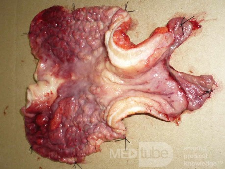 Endoscopy of Scirrhous Gastric Carcinoma involving the entire Fundus, Body and the Antrum (43 of 47)