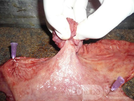 Polypoid Adenocarcinoma (4 of 9)