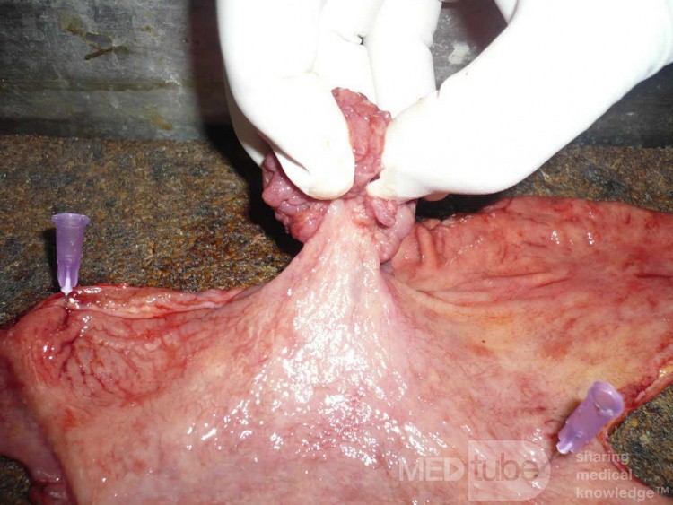Polypoid Adenocarcinoma (4 of 9)