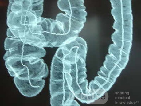 Adenocarcinoma of the Transverse Colon (9 of 15)