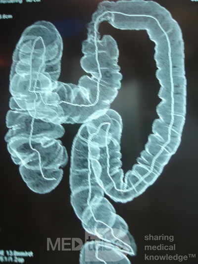 Adenocarcinoma of the Transverse Colon (9 of 15)