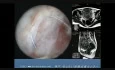 Hysteroscopic Resection of a Huge Myoma Weighting 360g 