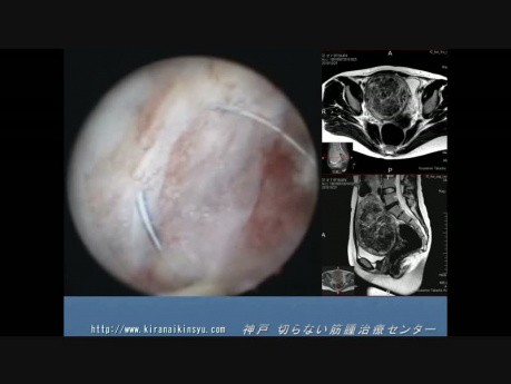 Hysteroscopic Resection of a Huge Myoma Weighting 360g 