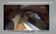 vNOTES Power Morcellation in Bag after Large Hysterectomy: A Surgical Innovation