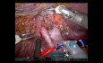 Robotic Exdended Left Hepatectomy and Biliary Reconstruction for Klatskin Tumour