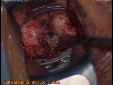 Cervical Double Microdiscectomy And Arthrodesis - Anterior Approach