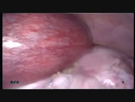 18 Wks Pregnancy with Large Ovarian Cyst Operated with Laparoscopy