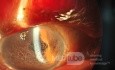 Reticular Epithelial Corneal Edema (RECE)