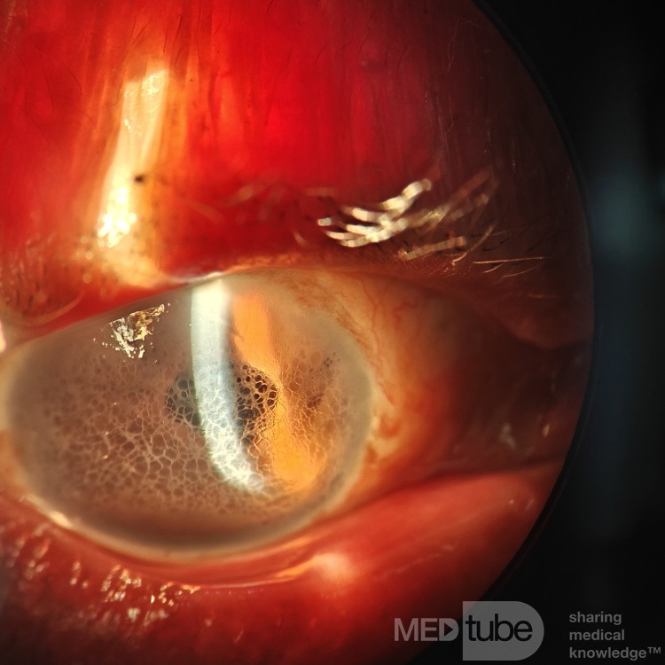 Reticular Epithelial Corneal Edema (RECE)