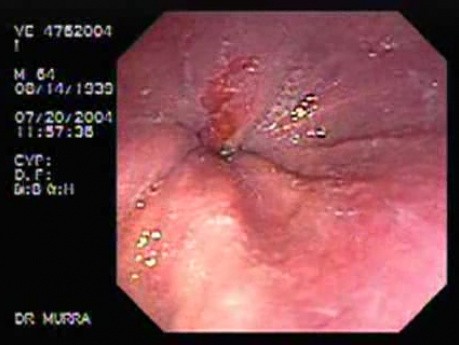 Barrett's Esophagus 