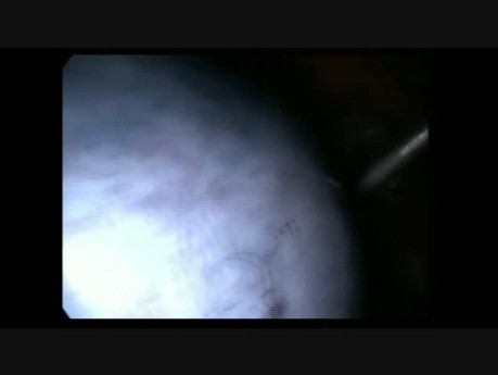 Laparoscopy Adenexal Torsion