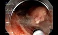 LST-G - Mixed Type - ESD Resection