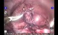 Robotic Nephrectomy