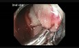 Cecum - Large Pedunculated Polyp Resection