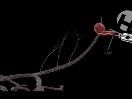 Correct Aneurysm Clipping