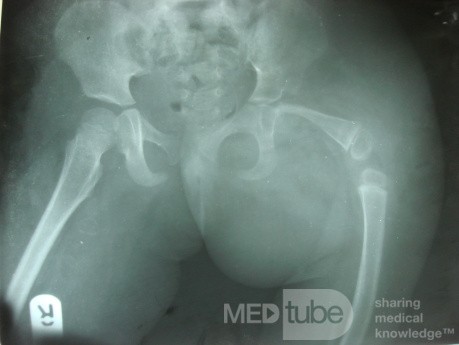 Proximal Focal Femoral Diffeciency