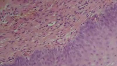 Cervical canal - Histopathological examination