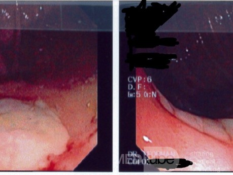 Cecal Ulcer due to NSAID's