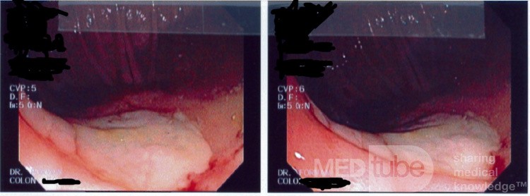Cecal Ulcer due to NSAID's
