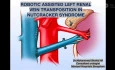 Robotic Assisted Left Renal Veintransposition in Nutcracker Syndrome