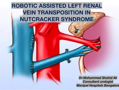 Robotic Assisted Left Renal Veintransposition in Nutcracker Syndrome