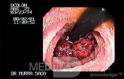 Rectum (9 of 30)