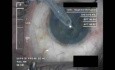 Cataract Surgery VI - Part 2