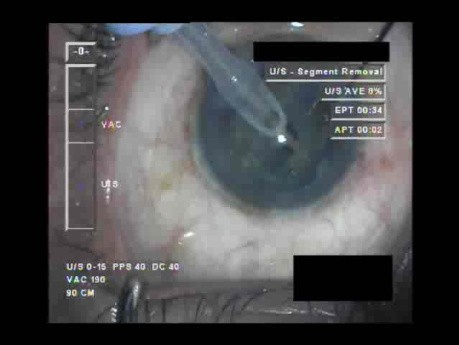 Cataract Surgery VI - Part 2