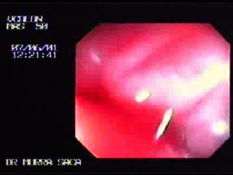 Bilobulated, Pediculated Villotubular Adenoma (1 of 2)