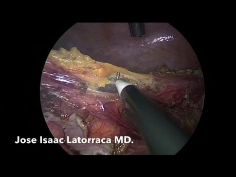 Laparoscopic Hartman Procedure