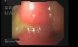 Gastric Ulceration Of The Lesser Curvature