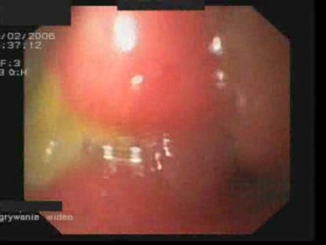 Gastric Ulceration Of The Lesser Curvature