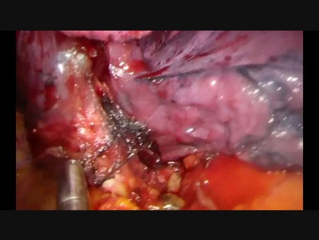 Subcostal Uniportal VATS Fissureless Left Lower Lobectomy