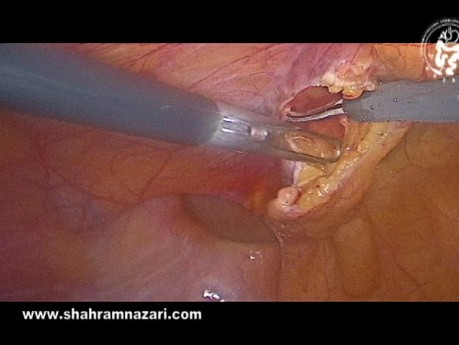 Respect the Layer Preserving the Transversalis Fascia in TAPP Hernia Repair