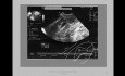 Ectopic Gestation Caesarean Scar