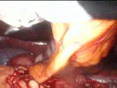 Gastrointestinal Stromal Tumor - GIST (49 of 65)