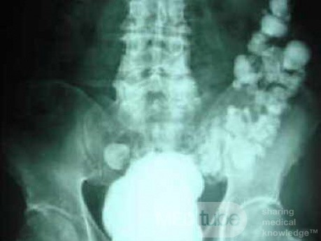 Sigmoid Diverticulitis - Colovesical Fistula (1 of 8)