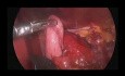 Fundoplication and Heller myotomy