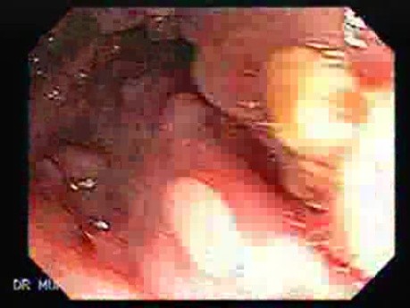 Familial Adenomatous Polyposis (5 of 36)