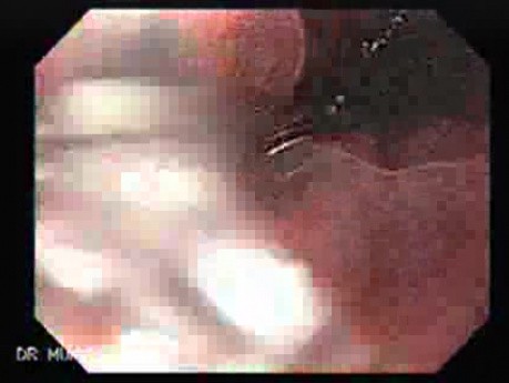 Pill Esophagitis - 1/5