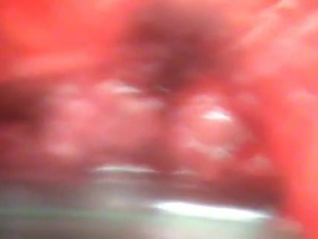 Perforation of a Esophageal Carcinoma after the procedure with hydrostatic balloon dilation (6 of 12)