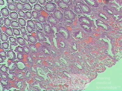 Case on Multiple Adenomas (large polyps) of the Rectum (35 of 37)