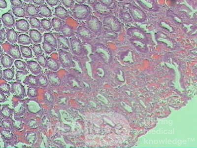 Case on Multiple Adenomas (large polyps) of the Rectum (35 of 37)