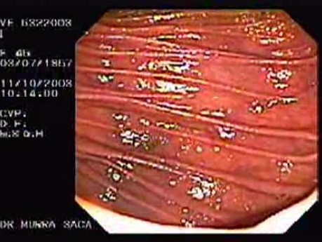 Enteroscopy (3 of 3)