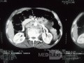 Pancreas cancer - 5