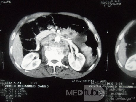 Pancreas cancer - 5
