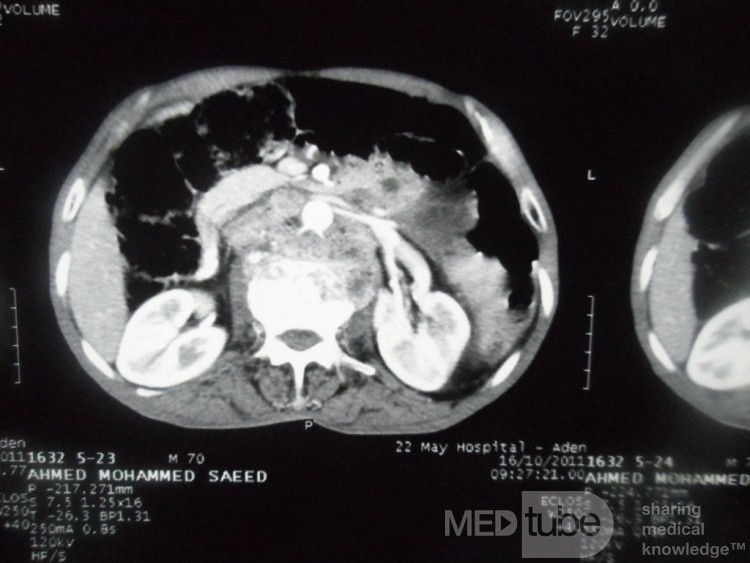 Pancreas cancer - 5